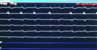 Implantace kardiostimulátoru